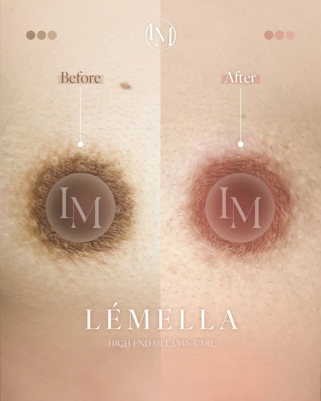 バストトップ(乳輪)