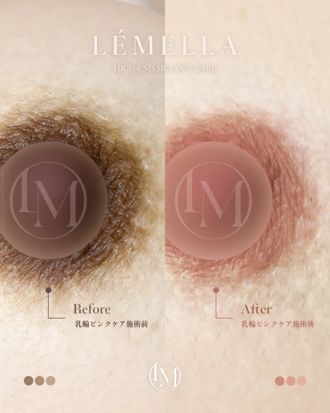 バストトップ(乳輪)